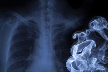 Lung cancer mortality in the wake of the changing smoking epidemic: a descriptive study of the global burden in ۲۰۲۰ and ۲۰۴۰